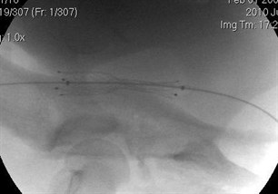 stent deplyed2 stent deplyed2
